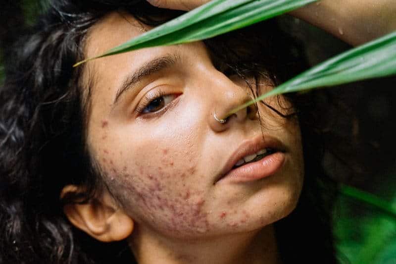 close-up of a woman's face with acne