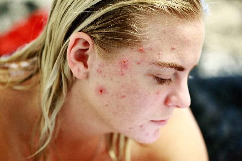 A close-up of a woman's face with acne, illustrating the type of skin condition that may benefit from sauna treatments.