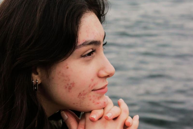 Profile view of a woman with acne-prone skin looking at water, showcasing active breakouts on cheek and jawline