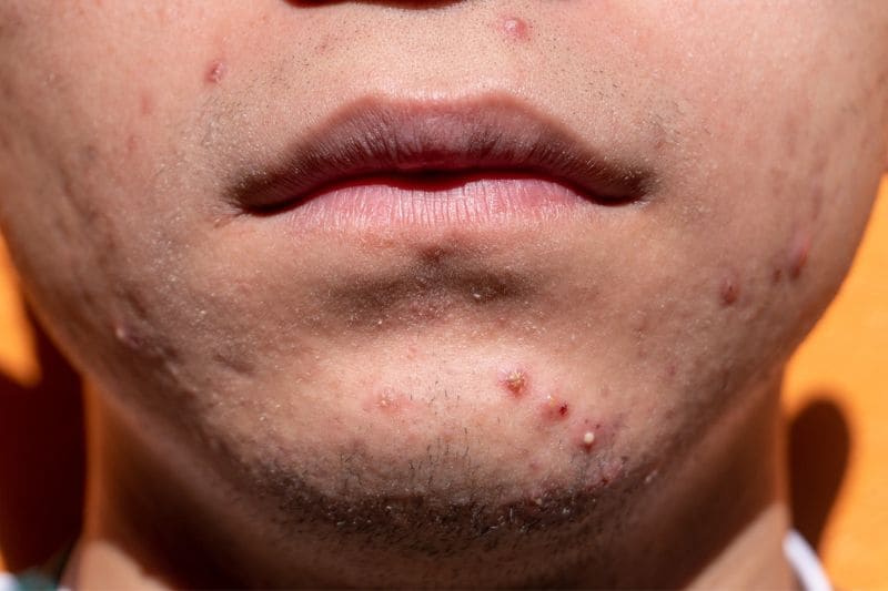 Close-up of lower face showing cystic acne around mouth and chin area