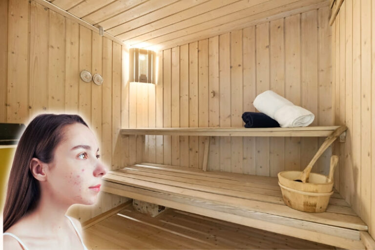 A woman with mild acne on her face with the background being an interior view of a wooden sauna with benches, towels, and a wooden bucket, as if wondering whether saunas help with acne?