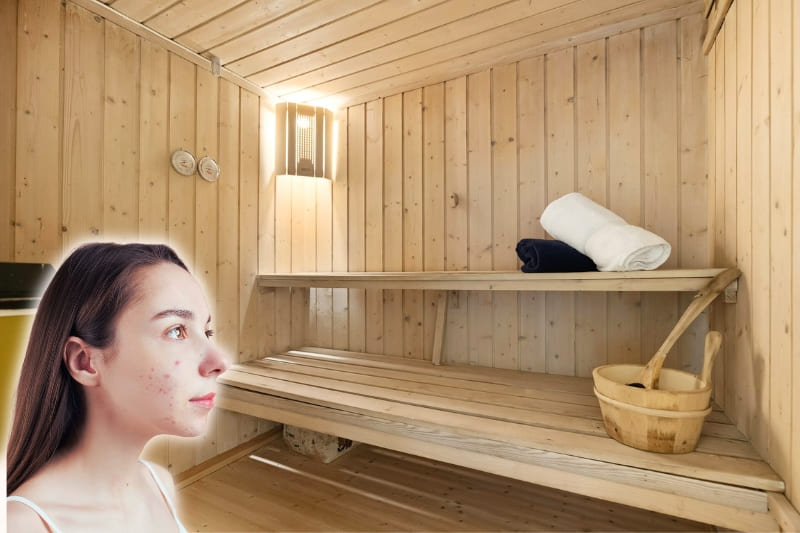 A woman with mild acne on her face with the background being an interior view of a wooden sauna with benches, towels, and a wooden bucket, as if wondering whether saunas help with acne?