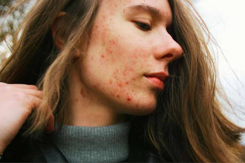 Close-up of a woman's face showing severe acne breakout on cheek and jawline