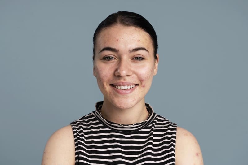 Portrait of a smiling young woman with visible acne on cheeks and forehead