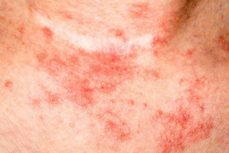 Close-up of eczema skin rash showing red, inflamed patches typical of atopic dermatitis