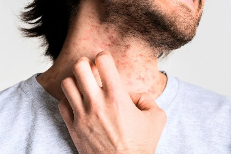 Man scratching neck during an eczema flare-up, demonstrating itchy and irritated skin