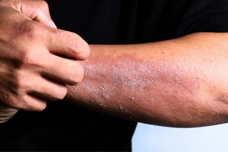 Severe eczema on arm with dry, flaky, and inflamed skin, illustrating chronic atopic dermatitis symptoms