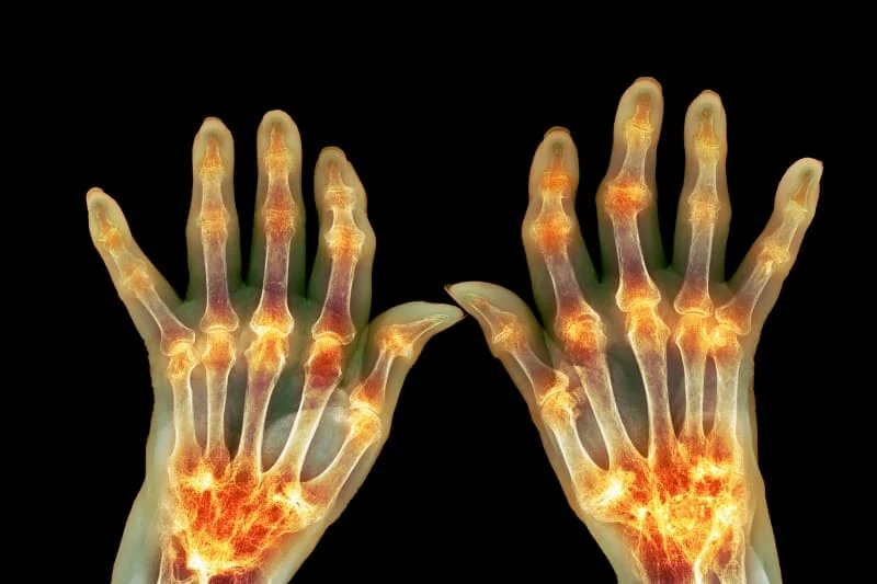 X-ray image showing inflammation in hands affected by rheumatoid arthritis with visible joint damage highlighted in orange