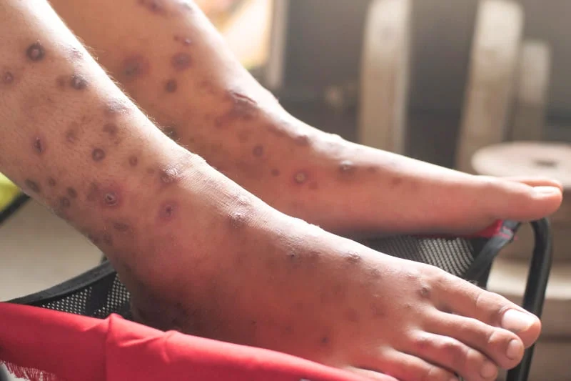 Widespread scabies rash and lesions on swollen legs caused by Sarcoptes scabiei mites, leading to intense itching, redness, and secondary skin infections.