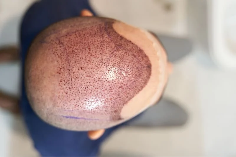 Close-up view of a freshly transplanted scalp with visible hair grafts healing after a hair transplant.