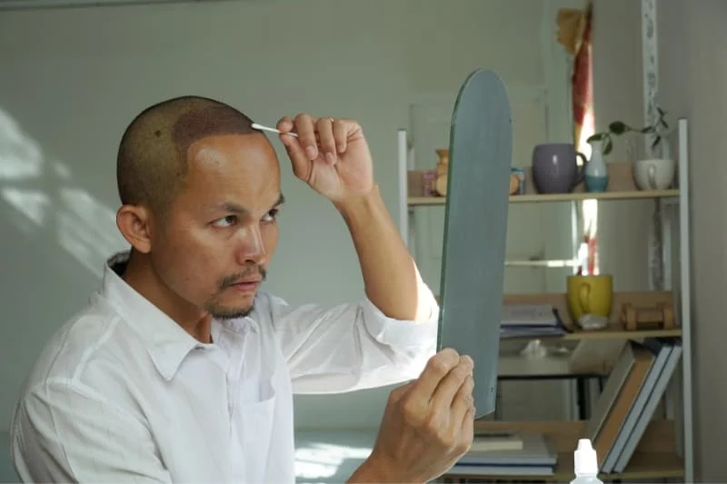 A man carefully examining his hair transplant in the mirror while applying post-transplant care.