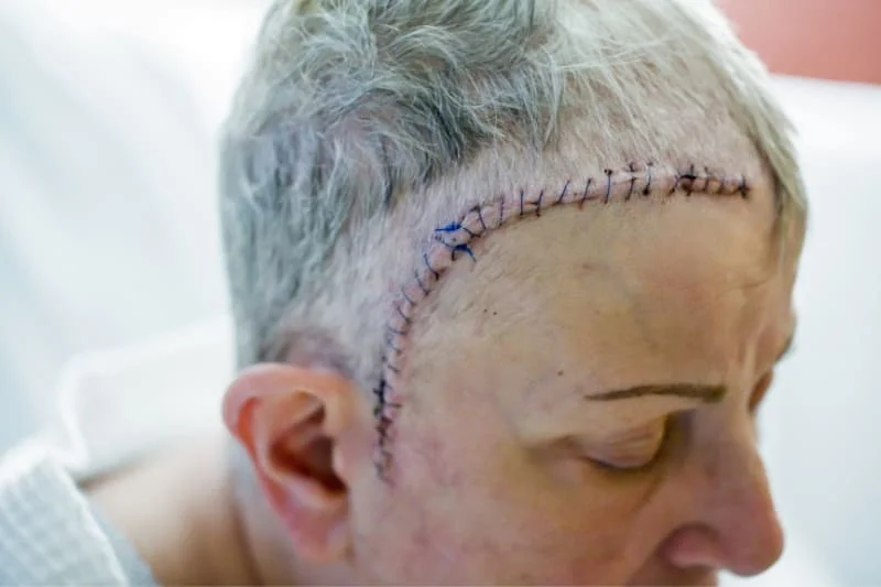 Fresh surgical incision with stitches on patient's head following cranial surgery, showing healing process that requires special care during recovery.