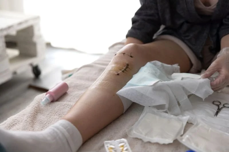 Patient receiving wound care for sutured knee incision after surgery, demonstrating recovery phase.