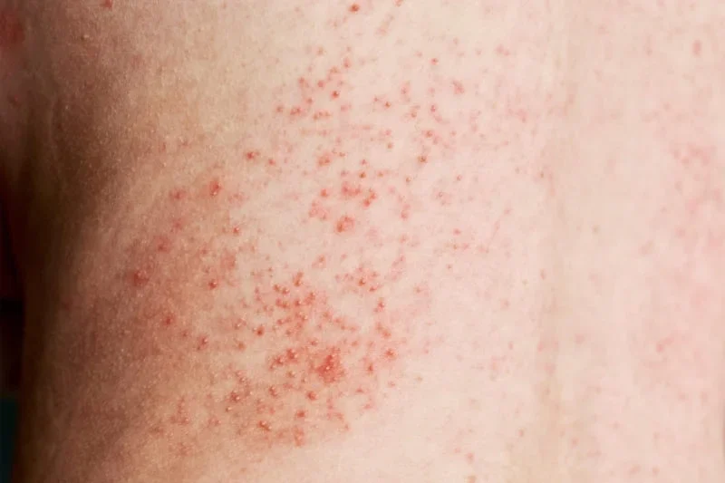 Close-up view of red heat rash bumps on skin showing typical miliaria rubra appearance