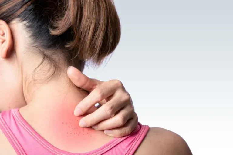 Woman scratching itchy heat rash from sauna on neck and shoulder area